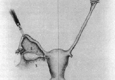 Read our article : "Ovarian transposition"